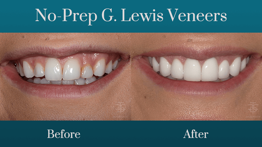 no-prep g. lewis veneers